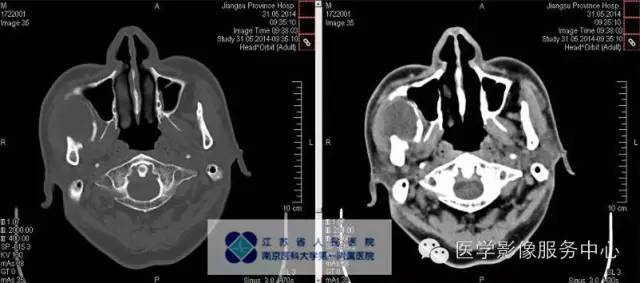【病例】造釉细胞瘤1例CT影像表现 【病例】造釉细胞瘤1例CT影像表现