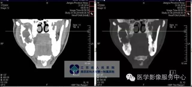 【病例】造釉细胞瘤1例CT影像表现 【病例】造釉细胞瘤1例CT影像表现