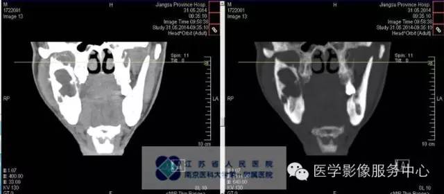 【病例】造釉细胞瘤1例CT影像表现