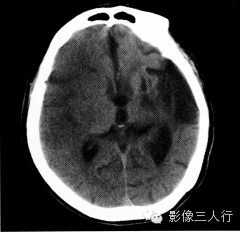 缺血性脑梗死的诊断要点及鉴别诊断