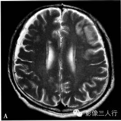缺血性脑梗死的诊断要点及鉴别诊断