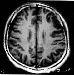 缺血性脑梗死的诊断要点及鉴别诊断