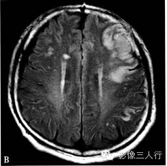 缺血性脑梗死的诊断要点及鉴别诊断