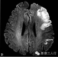 缺血性脑梗死的诊断要点及鉴别诊断