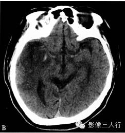 缺血性脑梗死的诊断要点及鉴别诊断
