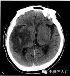 缺血性脑梗死的诊断要点及鉴别诊断