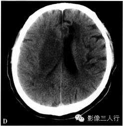 缺血性脑梗死的诊断要点及鉴别诊断