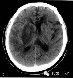 缺血性脑梗死的诊断要点及鉴别诊断