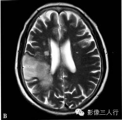 缺血性脑梗死的诊断要点及鉴别诊断