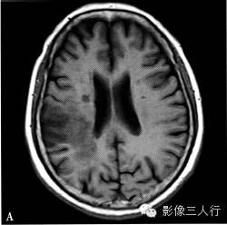 缺血性脑梗死的诊断要点及鉴别诊断