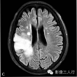 缺血性脑梗死的诊断要点及鉴别诊断