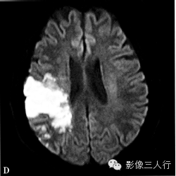 缺血性脑梗死的诊断要点及鉴别诊断