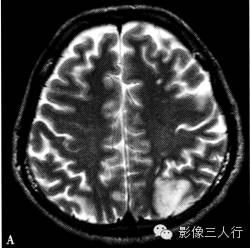 缺血性脑梗死的诊断要点及鉴别诊断
