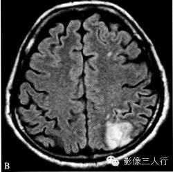 缺血性脑梗死的诊断要点及鉴别诊断