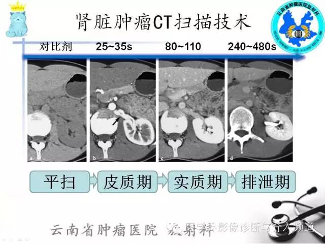 肾脏肿瘤CT扫描技术