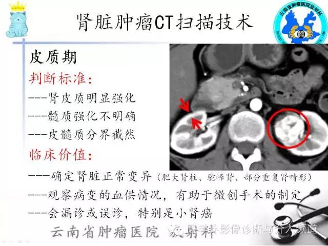 肾脏肿瘤CT扫描技术
