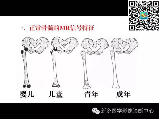 【PPT】髋部骨髓水肿综合征