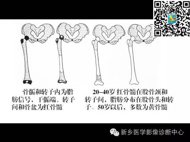 【PPT】髋部骨髓水肿综合征
