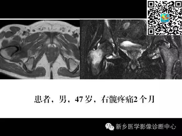 【PPT】髋部骨髓水肿综合征