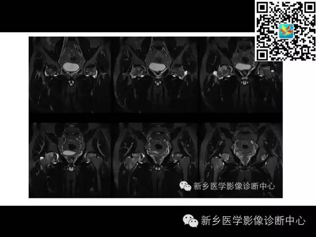 【PPT】髋部骨髓水肿综合征
