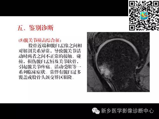 【PPT】髋部骨髓水肿综合征