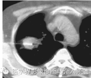 CT引导下穿刺活检术要点 CT引导下穿刺活检术要点