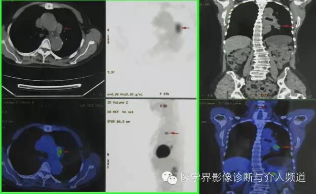 CT引导下穿刺活检术要点 CT引导下穿刺活检术要点