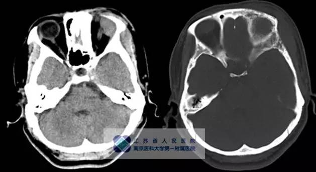 【病例】颅骨恶性淋巴瘤1例MR影像表现 【病例】颅骨恶性淋巴瘤1例MR影像表现