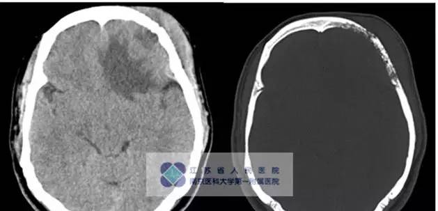 【病例】颅骨恶性淋巴瘤1例MR影像表现 【病例】颅骨恶性淋巴瘤1例MR影像表现