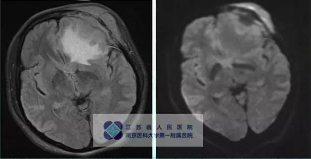 【病例】颅骨恶性淋巴瘤1例MR影像表现 【病例】颅骨恶性淋巴瘤1例MR影像表现