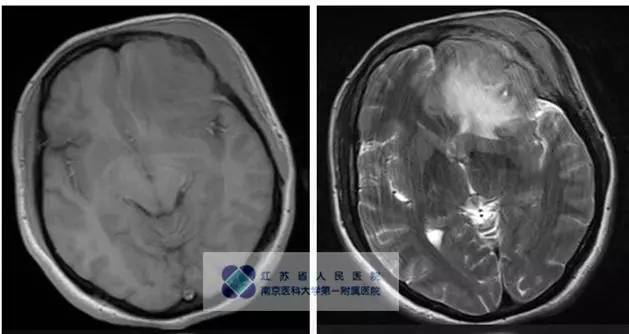 【病例】颅骨恶性淋巴瘤1例MR影像表现 【病例】颅骨恶性淋巴瘤1例MR影像表现