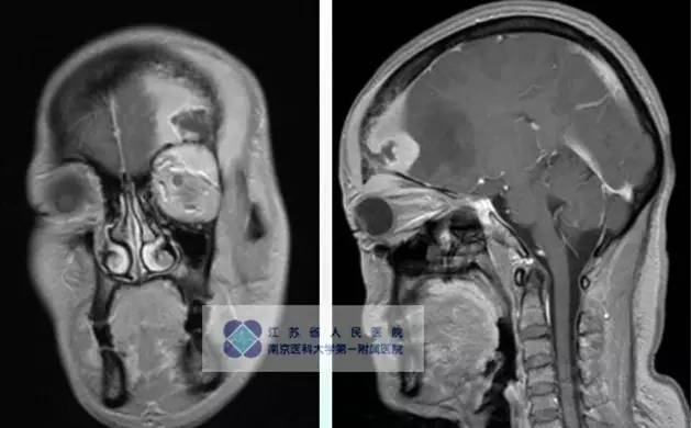 【病例】颅骨恶性淋巴瘤1例MR影像表现 【病例】颅骨恶性淋巴瘤1例MR影像表现