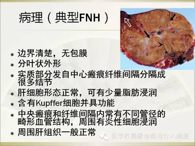 【PPT】肝脏局灶性结节性增生FNH的影像学诊断与鉴别诊断