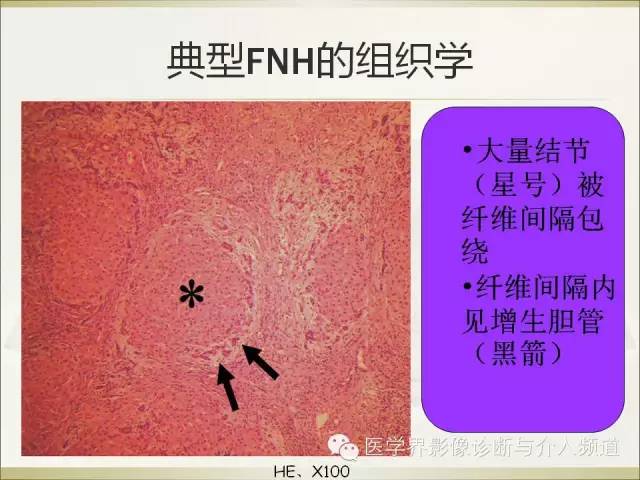 【PPT】肝脏局灶性结节性增生FNH的影像学诊断与鉴别诊断