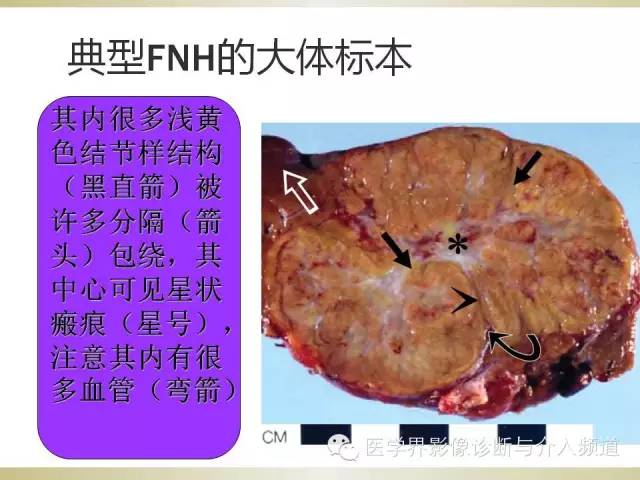 【PPT】肝脏局灶性结节性增生FNH的影像学诊断与鉴别诊断