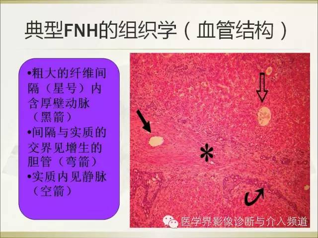 【PPT】肝脏局灶性结节性增生FNH的影像学诊断与鉴别诊断