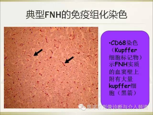 【PPT】肝脏局灶性结节性增生FNH的影像学诊断与鉴别诊断