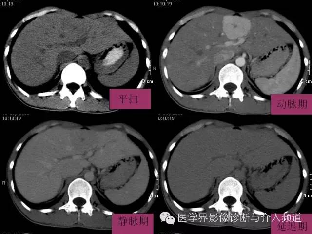 【PPT】肝脏局灶性结节性增生FNH的影像学诊断与鉴别诊断