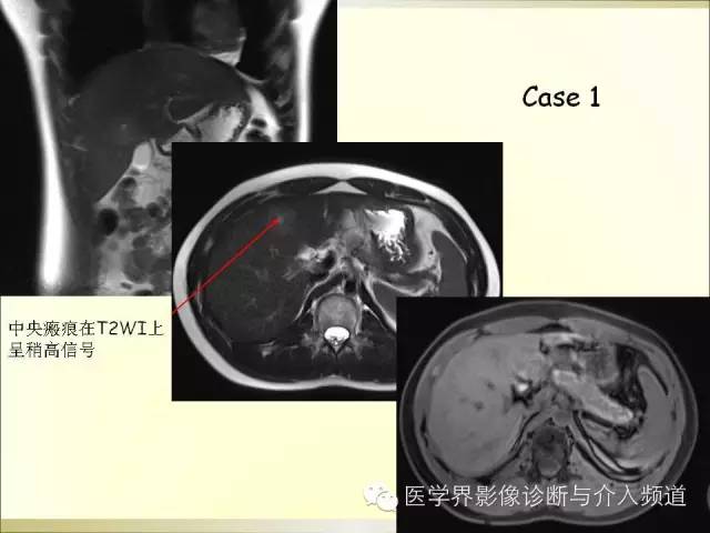 【PPT】肝脏局灶性结节性增生FNH的影像学诊断与鉴别诊断