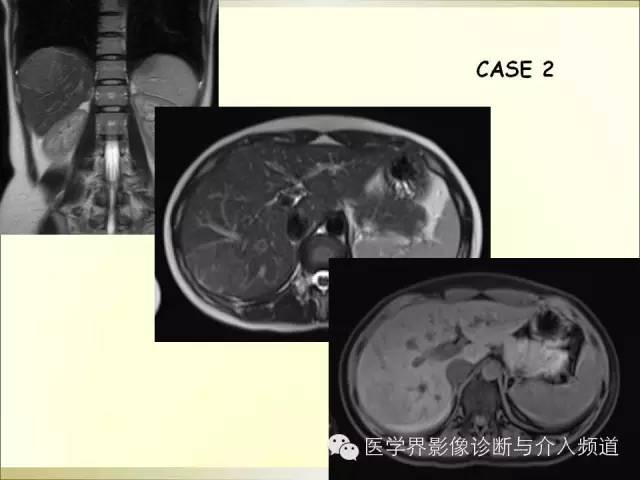 【PPT】肝脏局灶性结节性增生FNH的影像学诊断与鉴别诊断