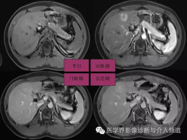 【PPT】肝脏局灶性结节性增生FNH的影像学诊断与鉴别诊断