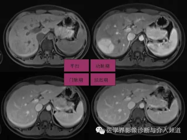 【PPT】肝脏局灶性结节性增生FNH的影像学诊断与鉴别诊断