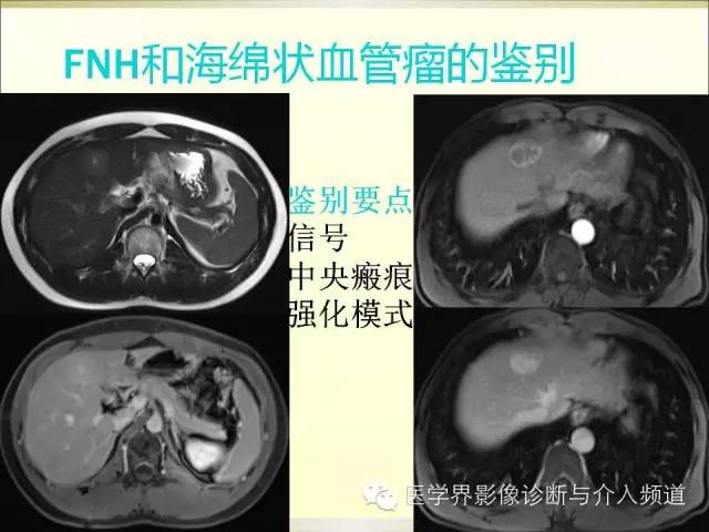 【PPT】肝脏局灶性结节性增生FNH的影像学诊断与鉴别诊断