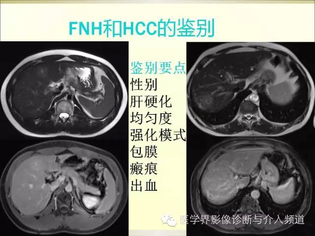 【PPT】肝脏局灶性结节性增生FNH的影像学诊断与鉴别诊断
