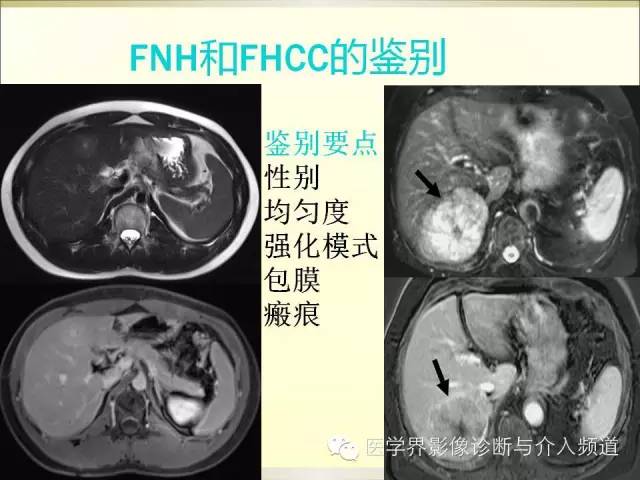 【PPT】肝脏局灶性结节性增生FNH的影像学诊断与鉴别诊断
