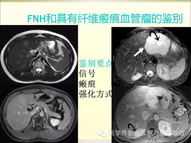 【PPT】肝脏局灶性结节性增生FNH的影像学诊断与鉴别诊断
