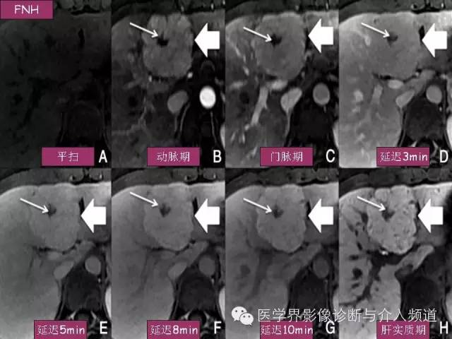 【PPT】肝脏局灶性结节性增生FNH的影像学诊断与鉴别诊断
