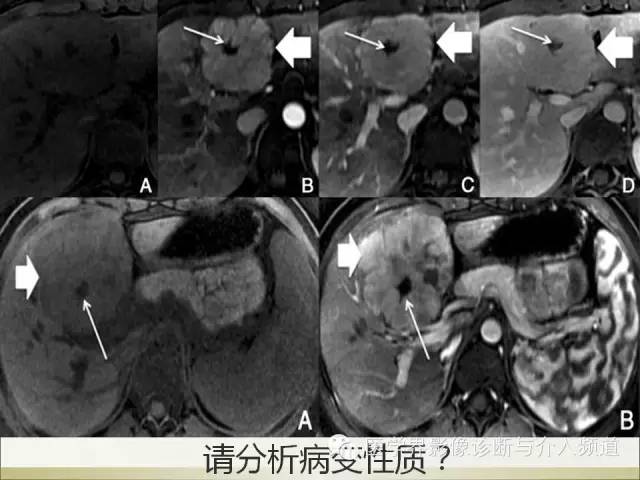 【PPT】肝脏局灶性结节性增生FNH的影像学诊断与鉴别诊断