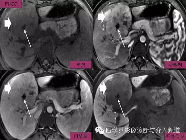 【PPT】肝脏局灶性结节性增生FNH的影像学诊断与鉴别诊断