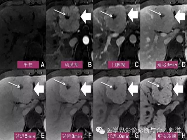 【PPT】肝脏局灶性结节性增生FNH的影像学诊断与鉴别诊断